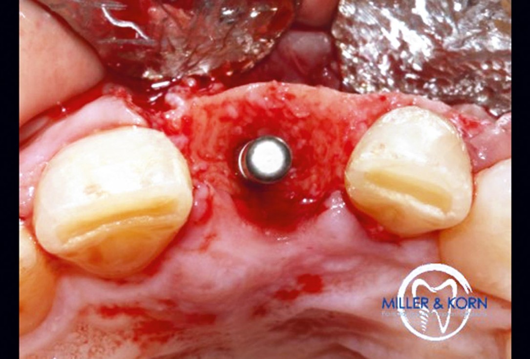 Immediate implant placement and correction of horizontal and vertical bone loss using an allograft bone ring, cerabone® and Jason® membrane - Drs. Miller and Korn
