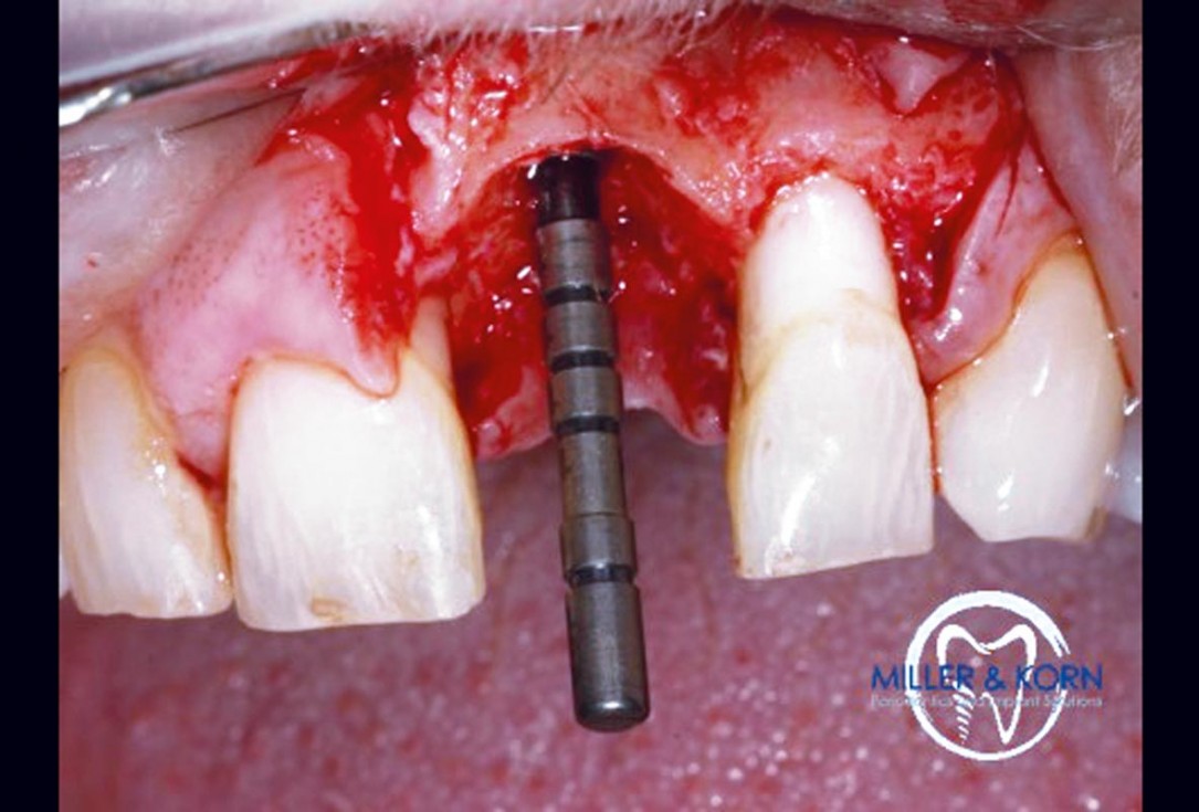 Immediate implant placement and correction of horizontal and vertical bone loss using an allograft bone ring, cerabone® and Jason® membrane - Drs. Miller and Korn
