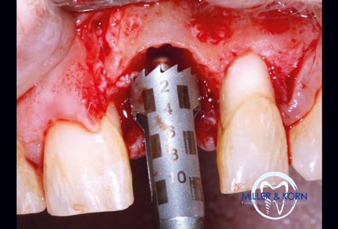 Immediate implant placement and correction of horizontal and vertical bone loss using an allograft bone ring, cerabone® and Jason® membrane - Drs. Miller and Korn