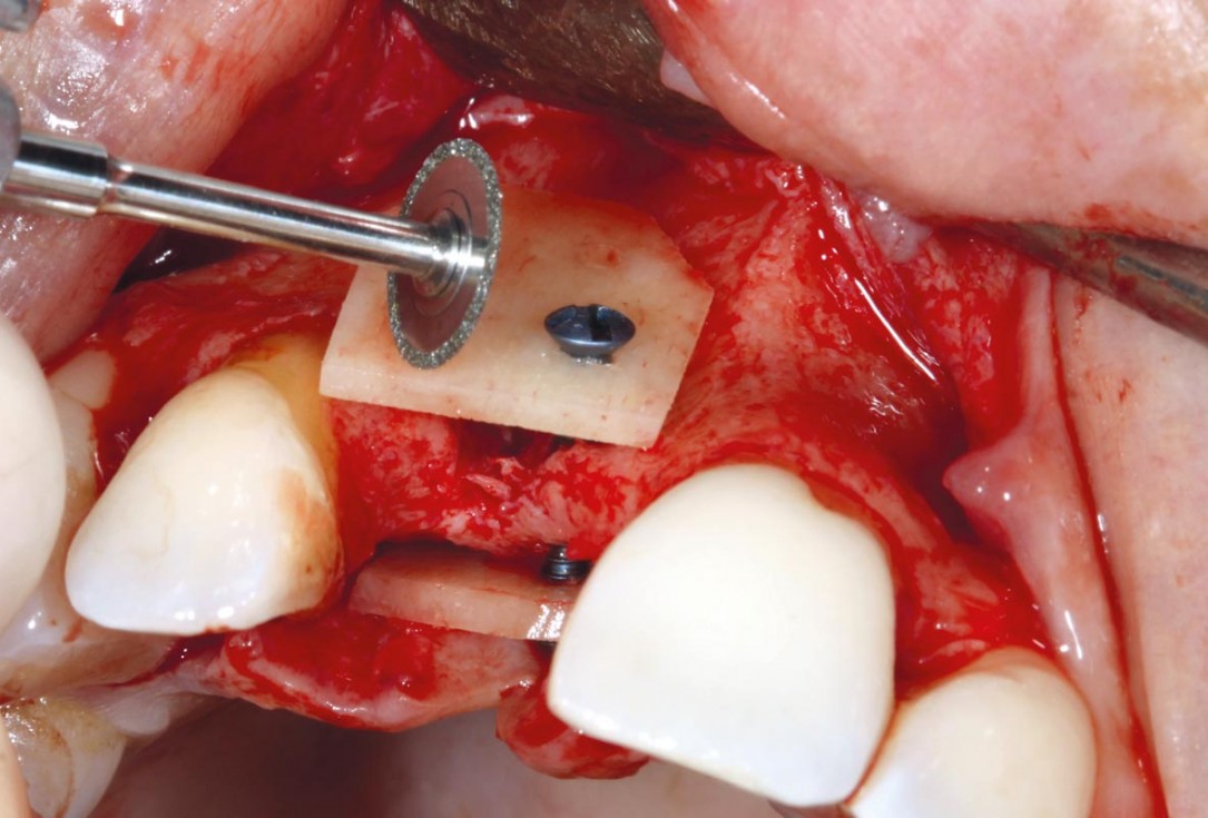 maxgraft® cortico at combined defect palatally and facially - Dr. K. Höckl