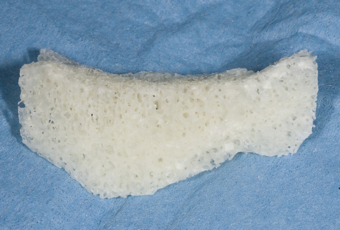 Ridge augmentation with maxgraft® bonebuilder - Dr. M. Jacotti