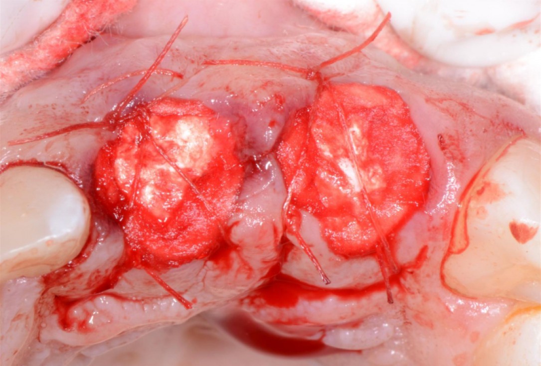 Ridge preservation with cerabone® Jason® membrane - Dr. D. Jelušić