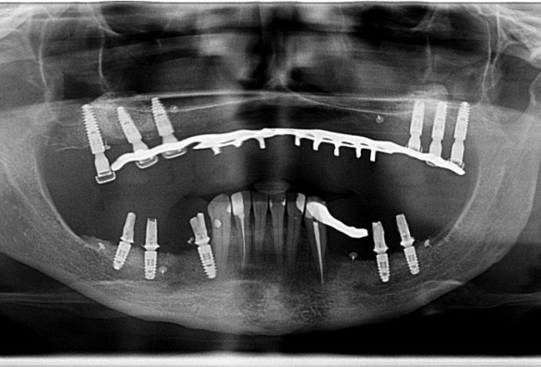 Vertical augmentation and sinus lift with maxgraft® bonering - Dr. O. Yüksel and Dr. B. Giesenhagen