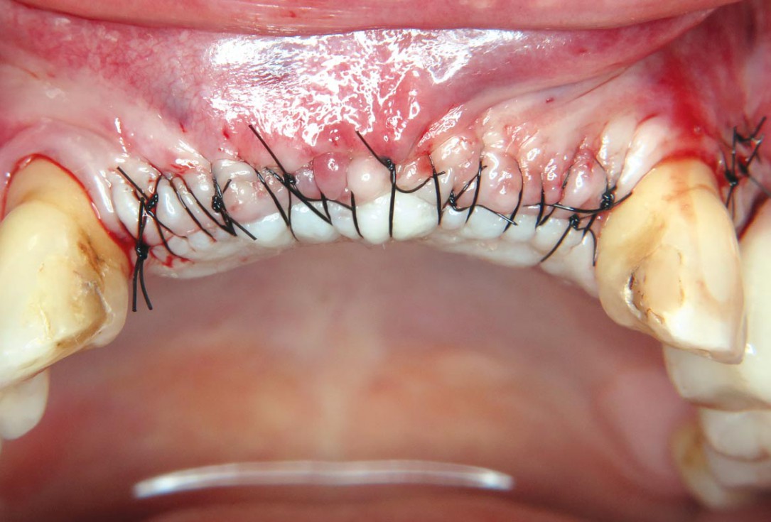 Three-dimensional augmentation with maxgraft® cortico - M.Sc. E. Kapogianni