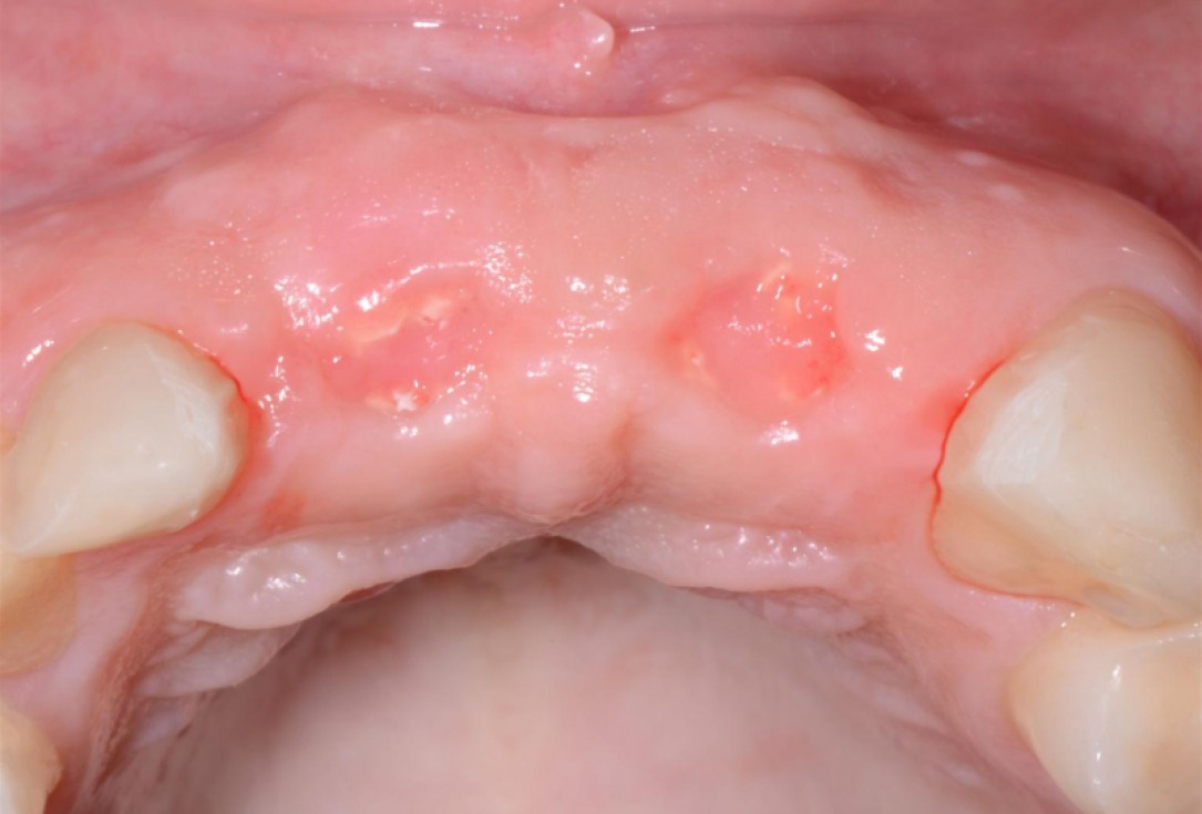 Ridge preservation with cerabone® Jason® membrane - Dr. D. Jelušić