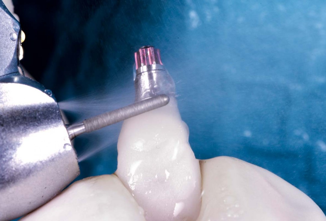 Excellent aesthetic result of buccal augmentation with mucoderm® and maxgraft® after immediate implant placement - 3-years follow-up - Dr. A. Puišys 