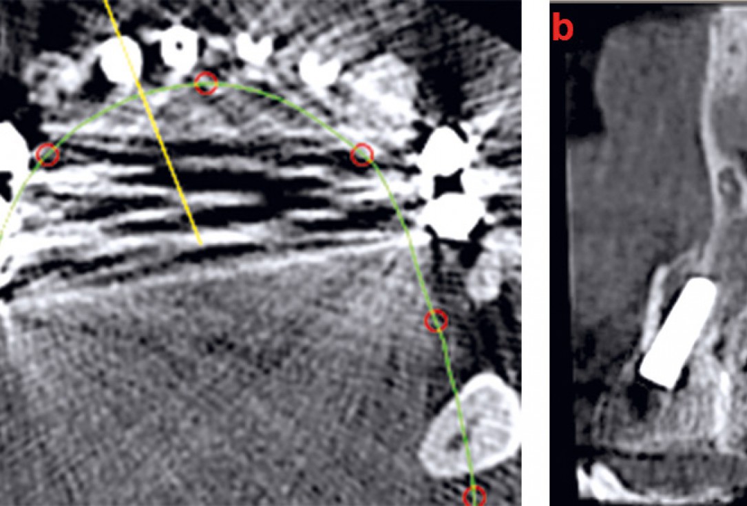 Three-dimensional augmentation with maxgraft® cortico - M.Sc. E. Kapogianni