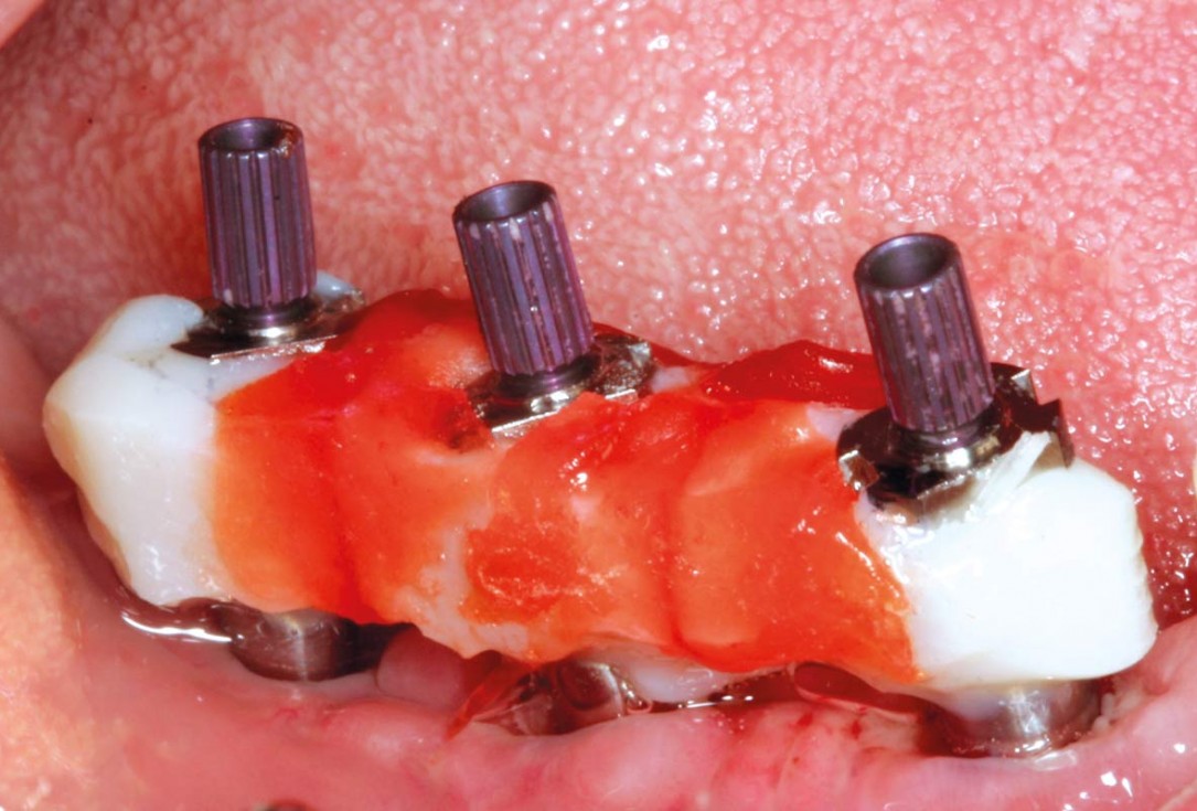 Horizontal ridge augmentation in the mandible with maxgraft® bonebuilder - Dr. O. Yüksel
