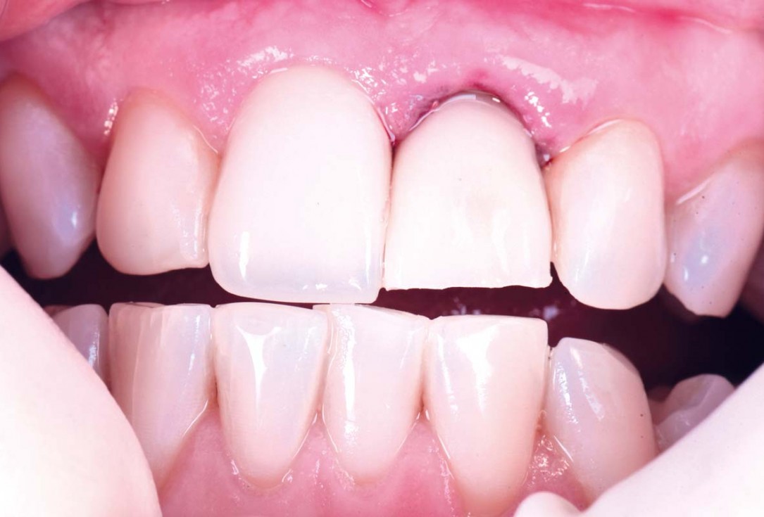 Excellent aesthetic result of buccal augmentation with mucoderm® and maxgraft® after immediate implant placement - 3-years follow-up - Dr. A. Puišys 