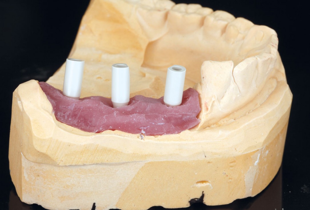 Horizontal ridge augmentation in the mandible with maxgraft® bonebuilder - Dr. O. Yüksel