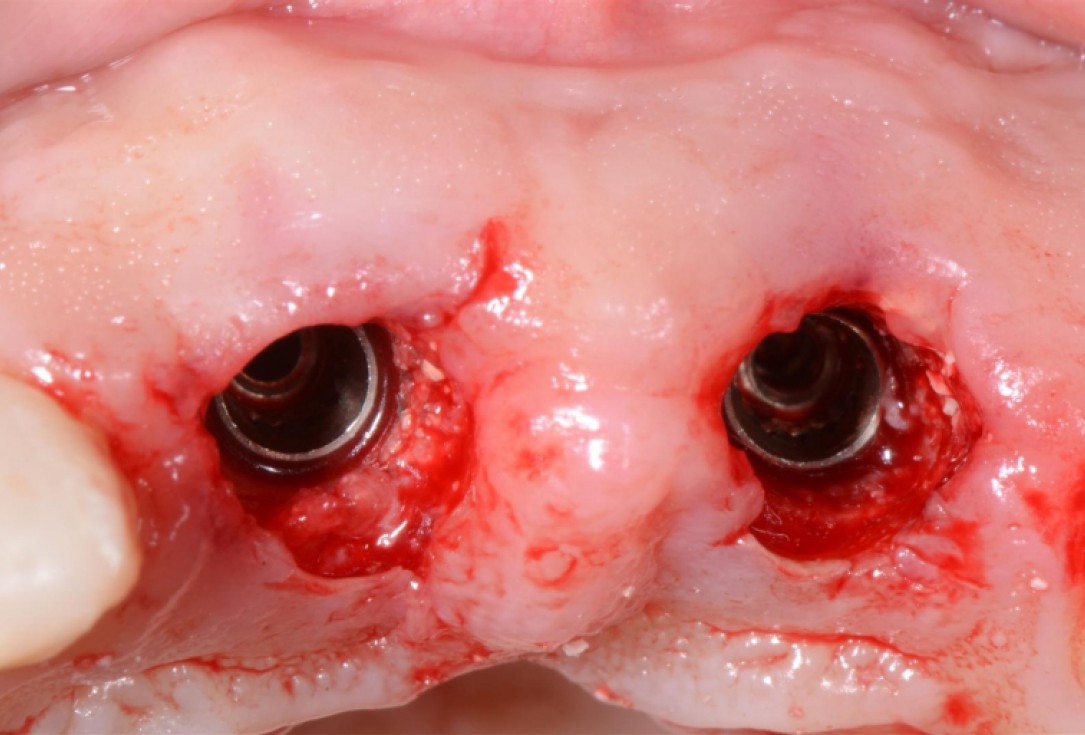 Ridge preservation with cerabone® Jason® membrane - Dr. D. Jelušić