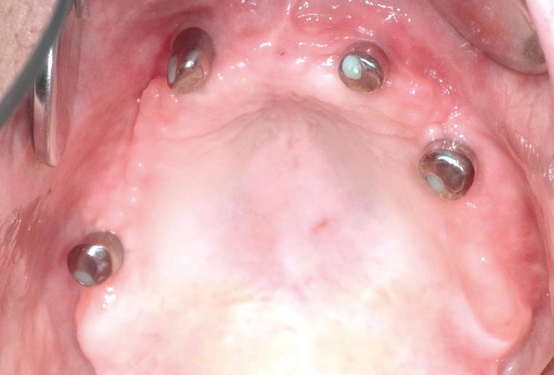 botiss maxgraft® bonebuilder for maxilla reconstruction - Clinical case