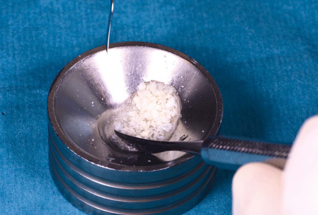 Excellent aesthetic result of buccal augmentation with mucoderm® and maxgraft® after immediate implant placement - 3-years follow-up - Dr. A. Puišys 