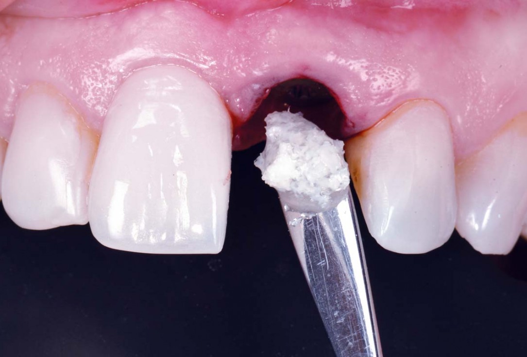 Excellent aesthetic result of buccal augmentation with mucoderm® and maxgraft® after immediate implant placement - 3-years follow-up - Dr. A. Puišys 