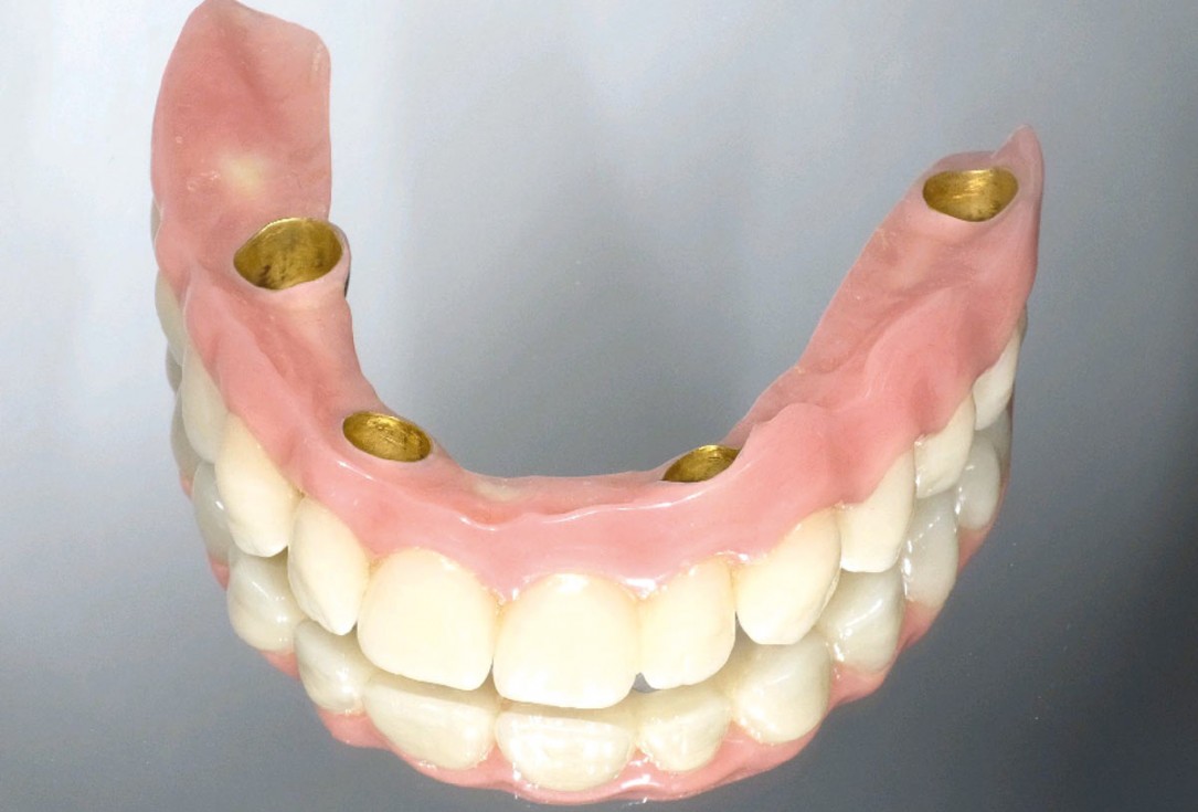 botiss maxgraft® bonebuilder for maxilla reconstruction - Clinical case