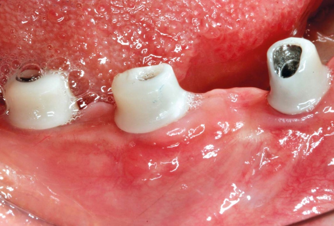 Horizontal ridge augmentation in the mandible with maxgraft® bonebuilder - Dr. O. Yüksel