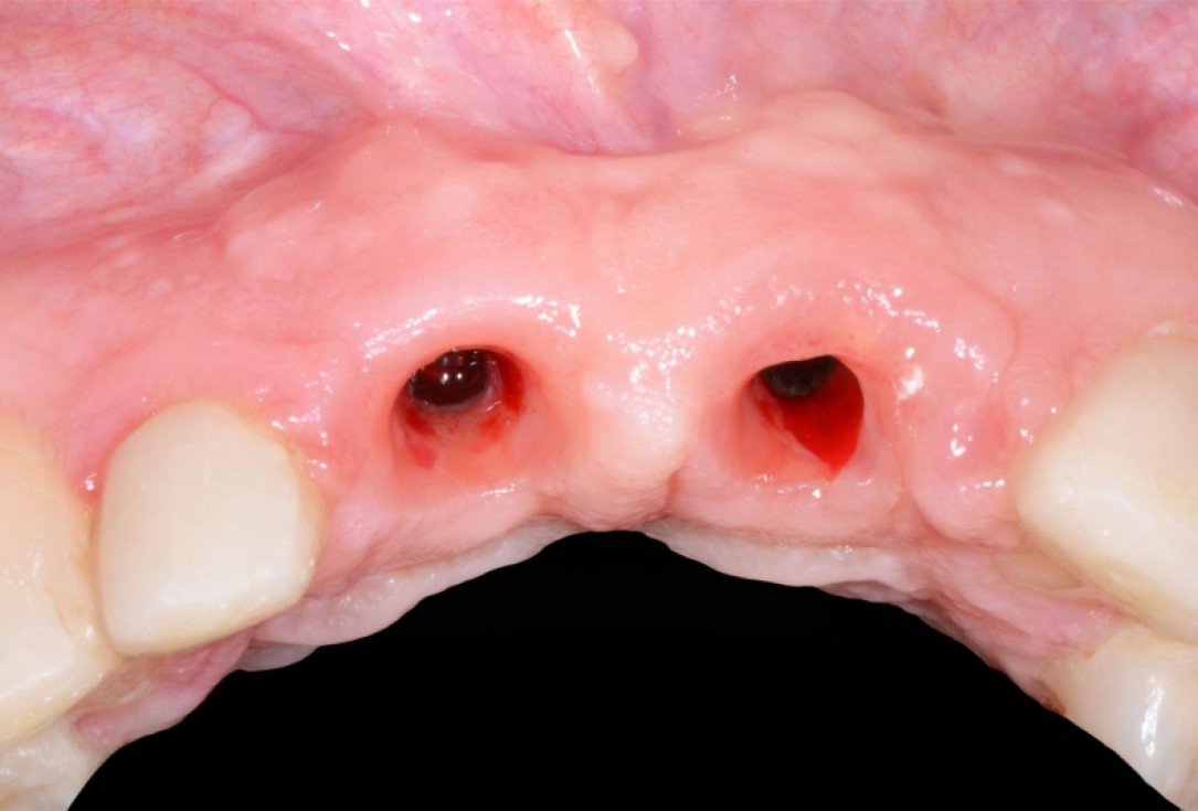 Ridge preservation with cerabone® Jason® membrane - Dr. D. Jelušić