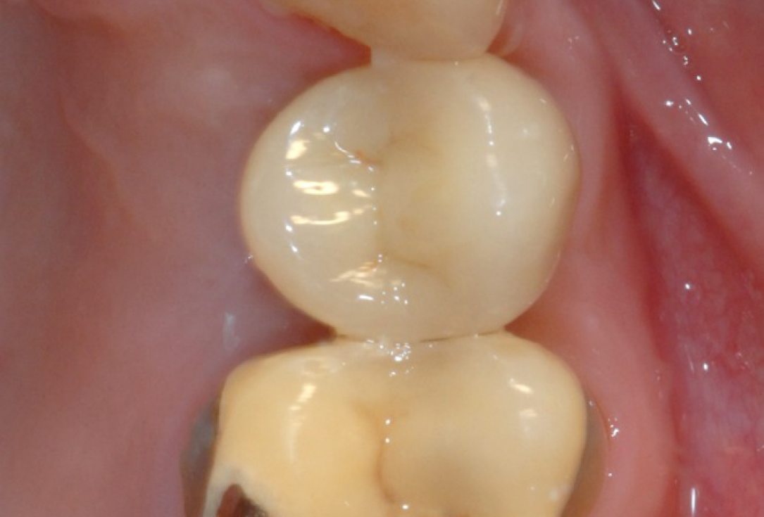 Ridge preservation with cerabone® and Jason® membrane - Dr. Derk Siebers