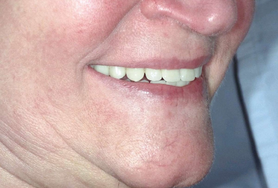 botiss maxgraft® bonebuilder for maxilla reconstruction - Clinical case