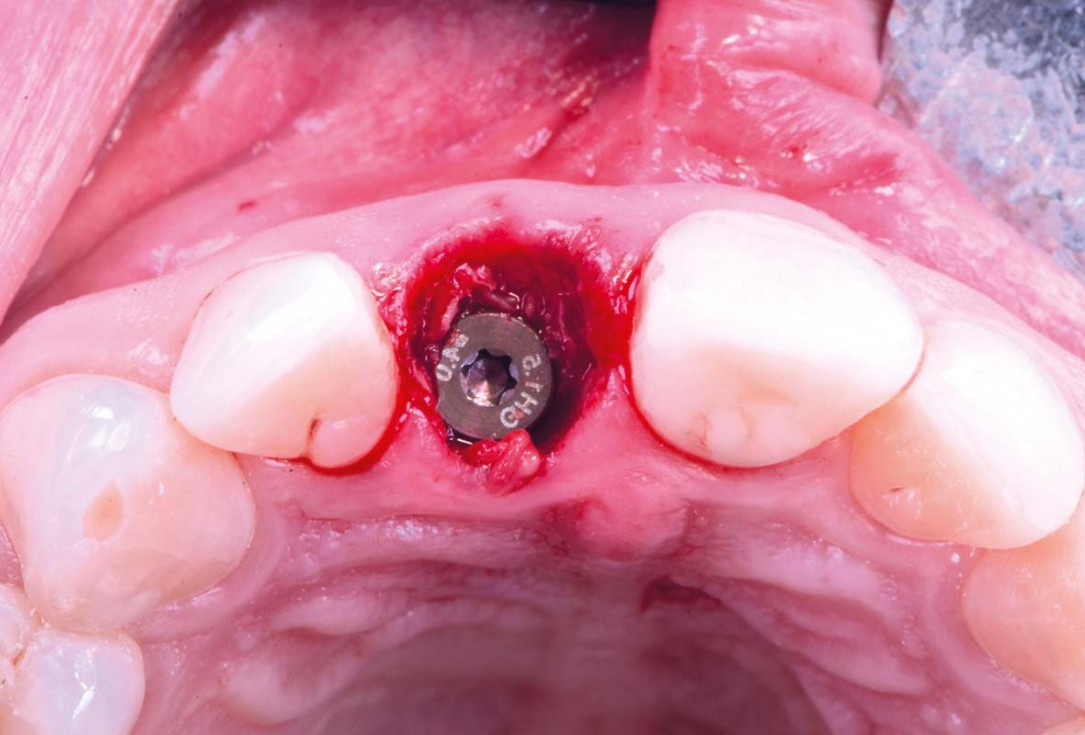 Excellent aesthetic result of buccal augmentation with mucoderm® and maxgraft® after immediate implant placement - 3-years follow-up - Dr. A. Puišys 