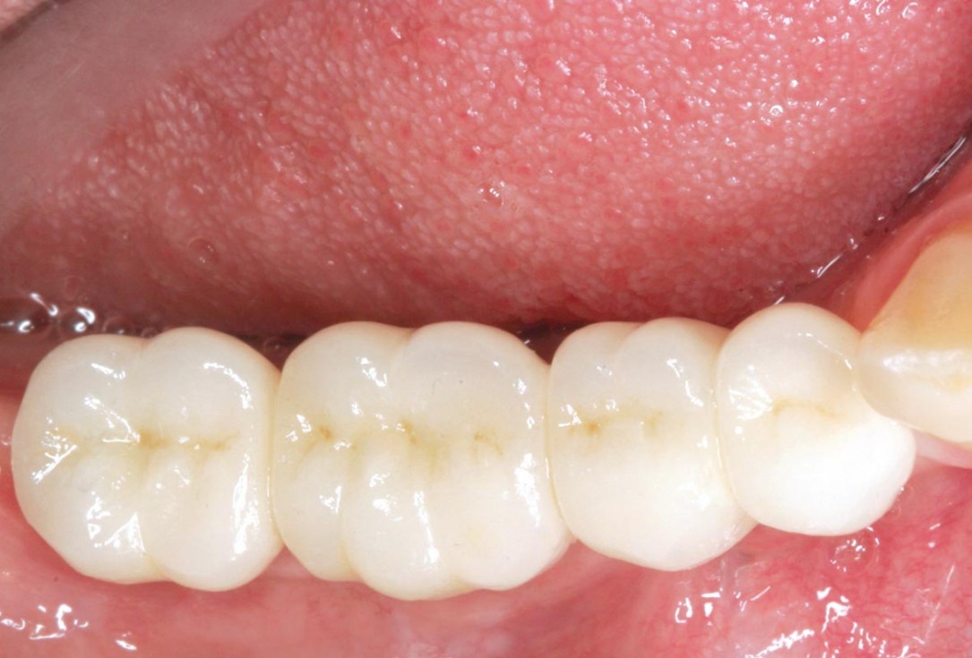 Horizontal ridge augmentation in the mandible with maxgraft® bonebuilder - Dr. O. Yüksel