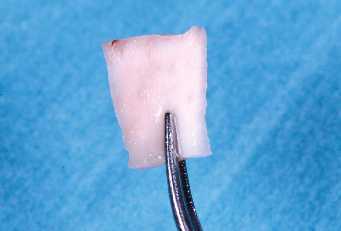 Excellent aesthetic result of buccal augmentation with mucoderm® and maxgraft® after immediate implant placement - 3-years follow-up - Dr. A. Puišys 