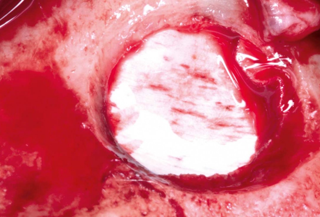 10/35 Maxillary sinus cyst removal using the Crocodile Technique and subsequent lateral sinus lift with cerabone®, maxgraft® and Jason® membrane - Dres. C. Scognamiglio and A. Perucchi