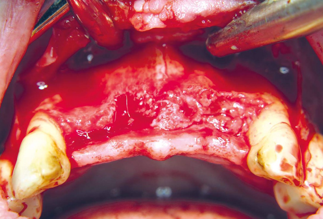 Three-dimensional augmentation with maxgraft® cortico - M.Sc. E. Kapogianni