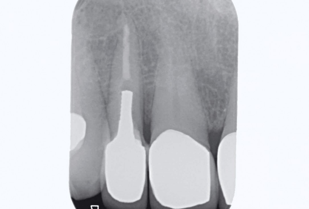 Bone augementation with maxresorb® - Dr. R. Cutts
