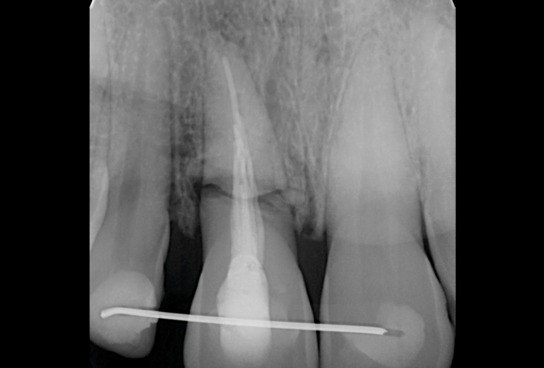 Type II socket defect grafted and repaired in a flapless way using Jason® membrane and maxgraft® cortico-cancellous - Dr. A. Jones