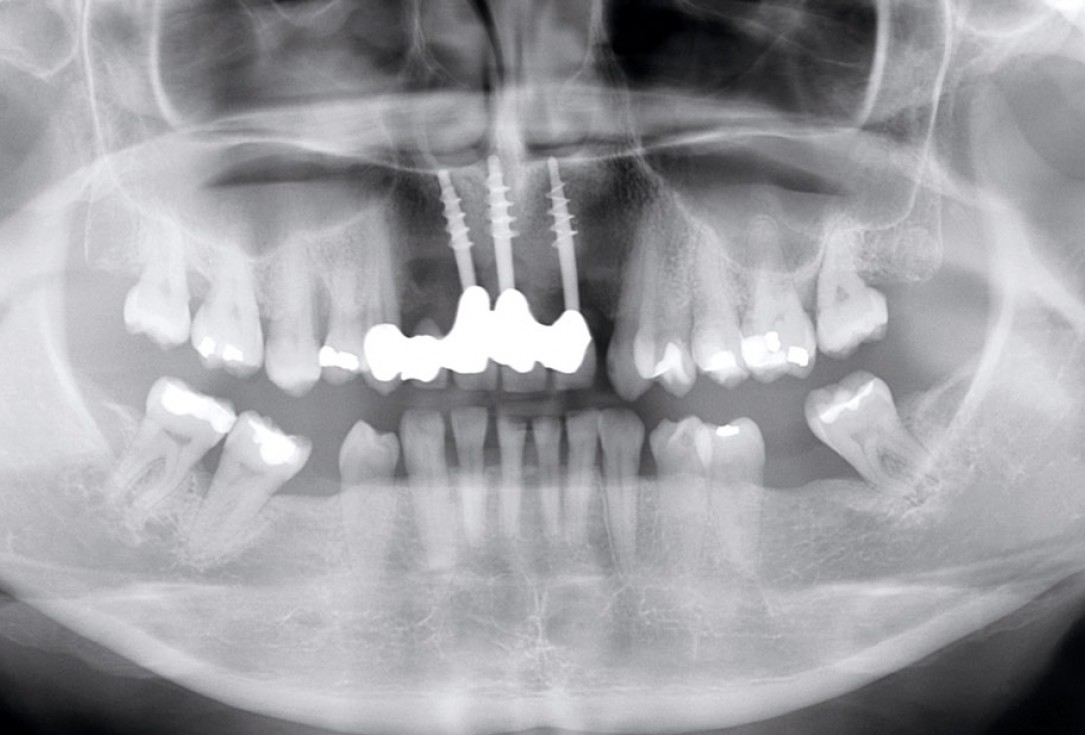 botiss maxgraft® bonebuilder aesthetic reconstruction - Clinical case