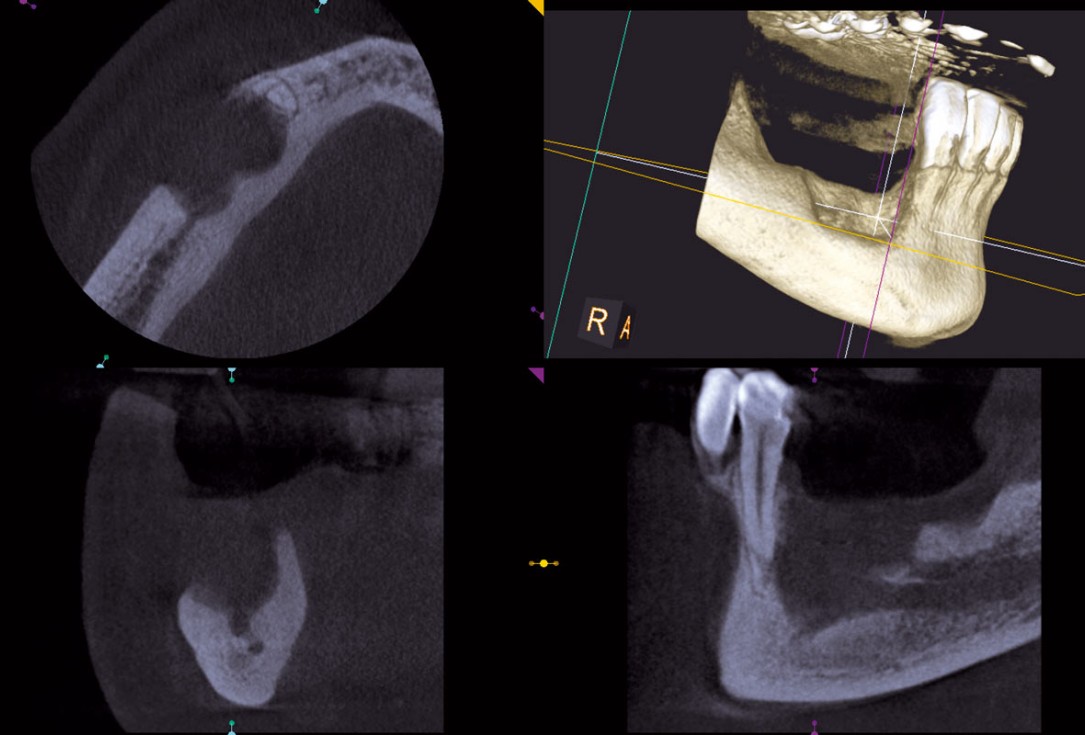 botiss maxgraft® bonebuilder for mandibular reconstruction - Clinical case