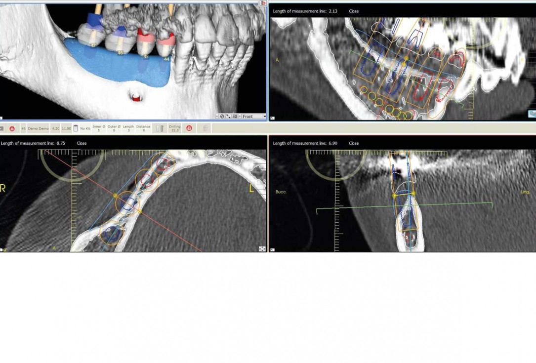 Horizontal ridge augmentation in the mandible with maxgraft® bonebuilder - Dr. O. Yüksel