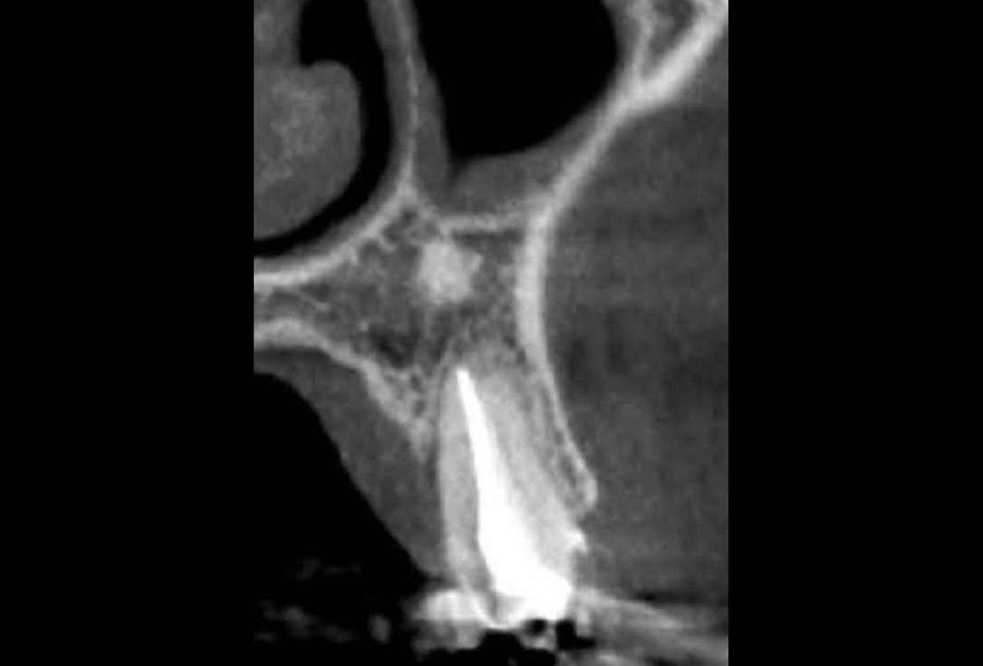 Full bone regeneration in extraction socket augmented with maxgraft® and Jason® membrane – Dr. C. Landsberg