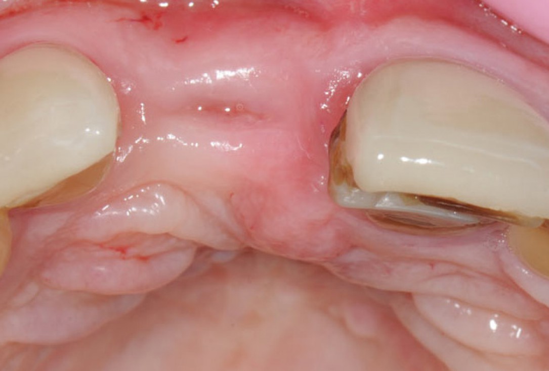 Restoration of buccal bone lamella in aesthetic zone with maxgraft® bonering - Dr. A. Patel