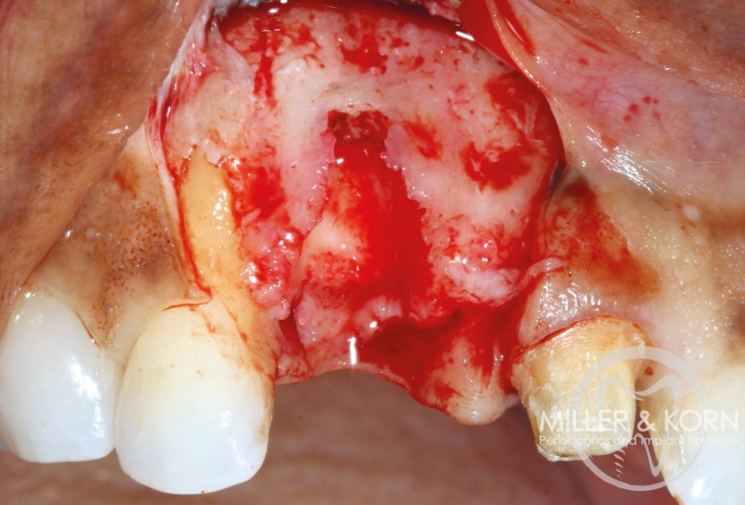 Immediate implant placement and regeneration of ridge using an allograft bone ring and Jason® membrane - Drs. Miller and Korn