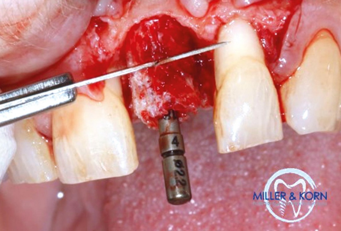 Immediate implant placement and correction of horizontal and vertical bone loss using an allograft bone ring, cerabone® and Jason® membrane - Drs. Miller and Korn