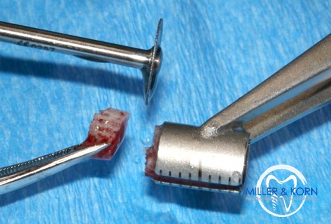 Immediate implant placement and correction of horizontal and vertical bone loss using an allograft bone ring, cerabone® and Jason® membrane - Drs. Miller and Korn