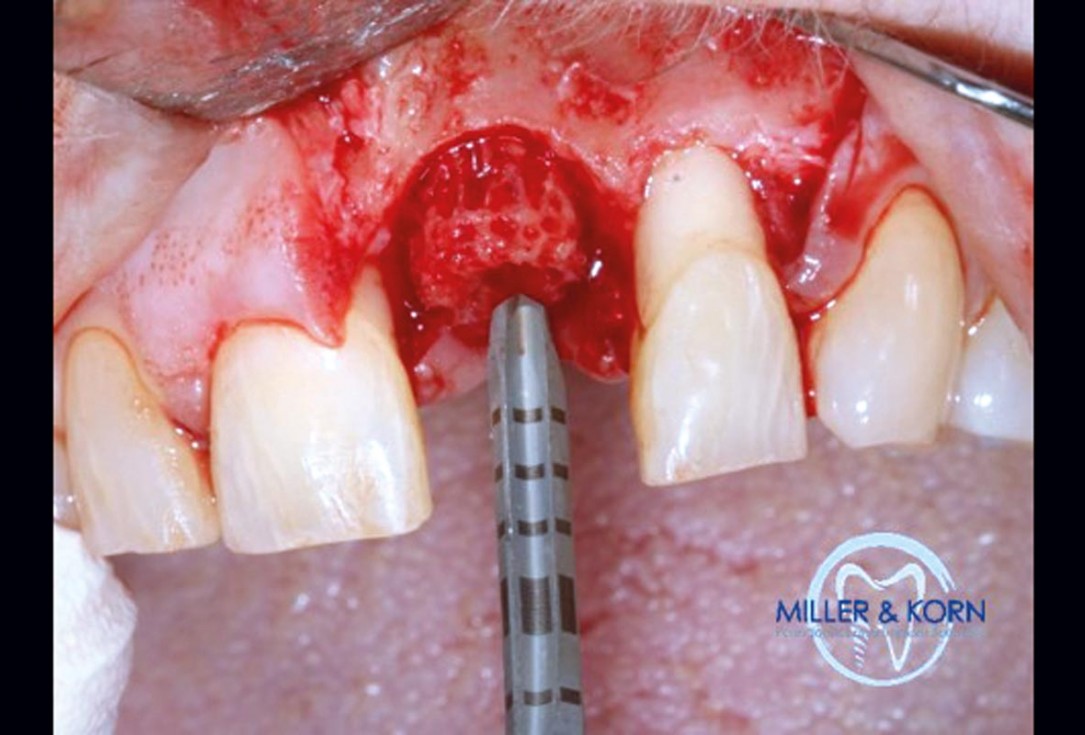 Immediate implant placement and correction of horizontal and vertical bone loss using an allograft bone ring, cerabone® and Jason® membrane - Drs. Miller and Korn