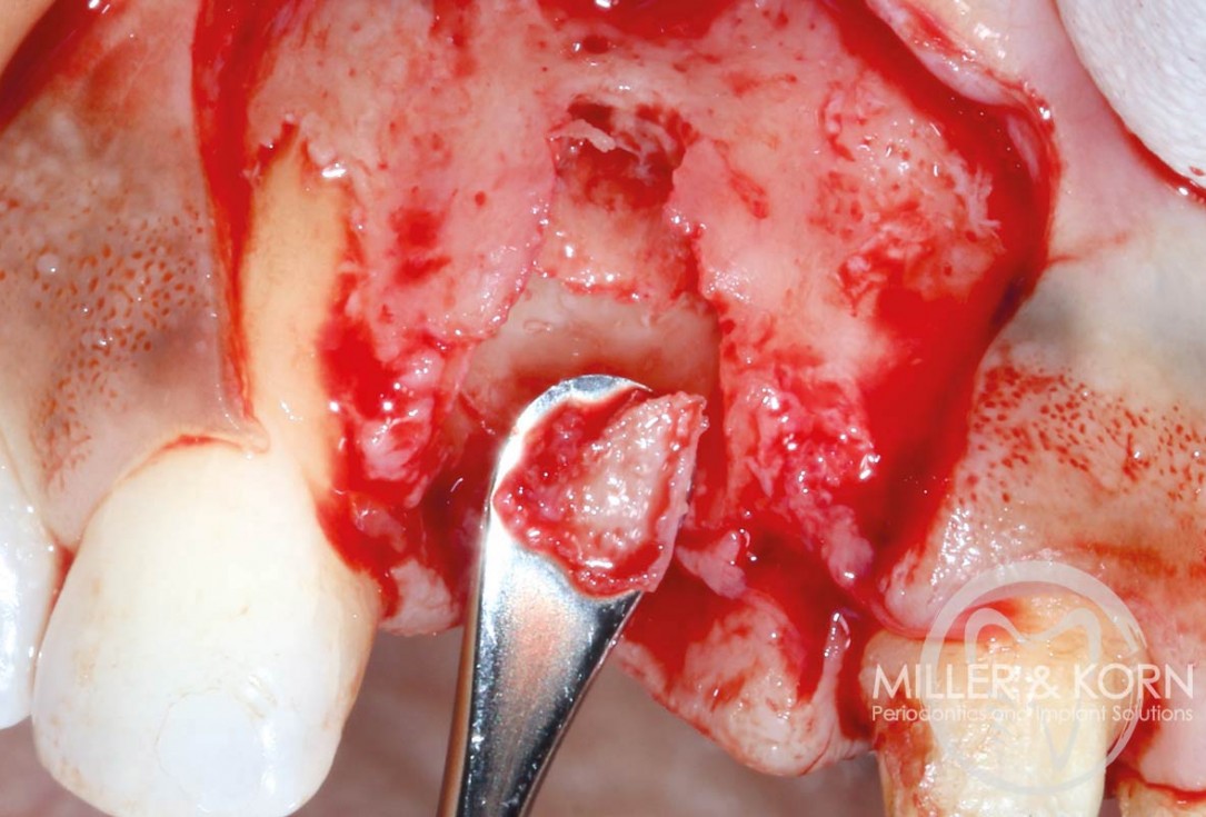 Immediate implant placement and regeneration of ridge using an allograft bone ring and Jason® membrane - Dr. Miller and Korn