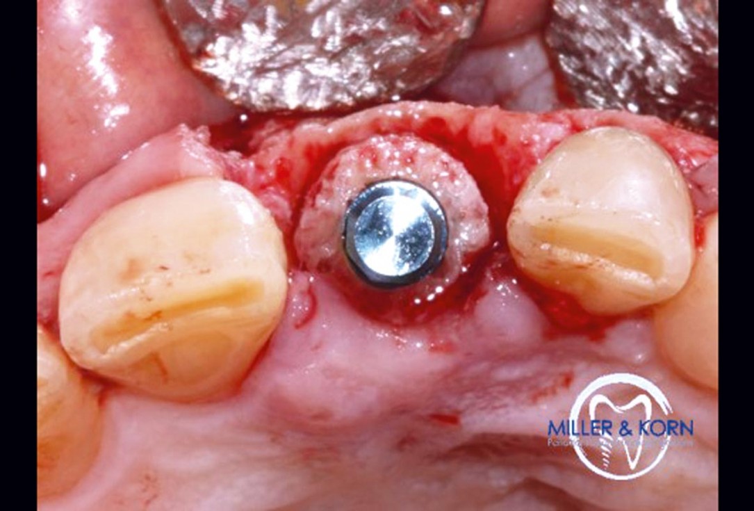 Immediate implant placement and correction of horizontal and vertical bone loss using an allograft bone ring, cerabone® and Jason® membrane - Drs. Miller and Korn