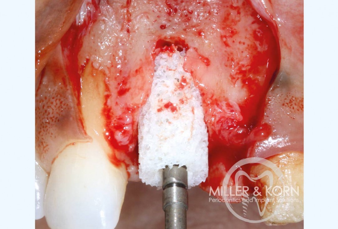 Immediate implant placement and regeneration of ridge using an allograft bone ring and Jason® membrane - Dr. Miller and Korn