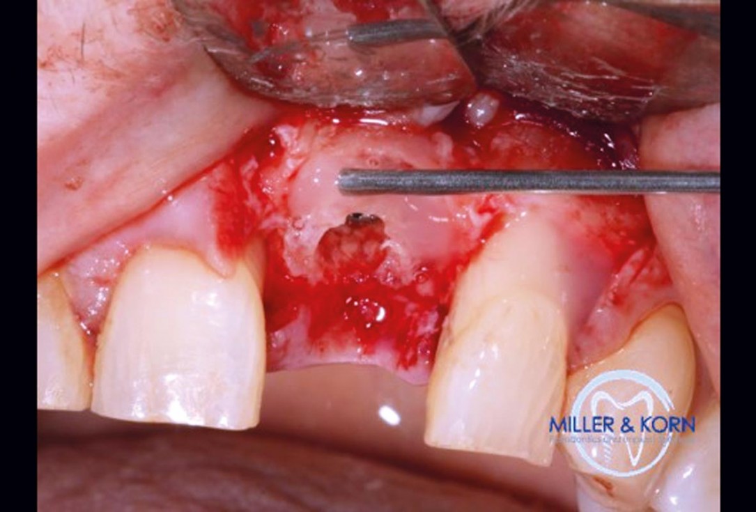 Immediate implant placement and correction of horizontal and vertical bone loss using an allograft bone ring, cerabone® and Jason® membrane - Drs. Miller and Korn