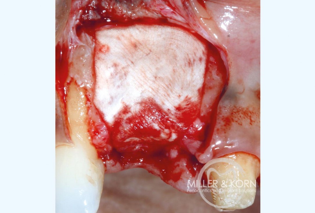 Immediate implant placement and regeneration of ridge using an allograft bone ring and Jason® membrane - Dr. Miller and Korn