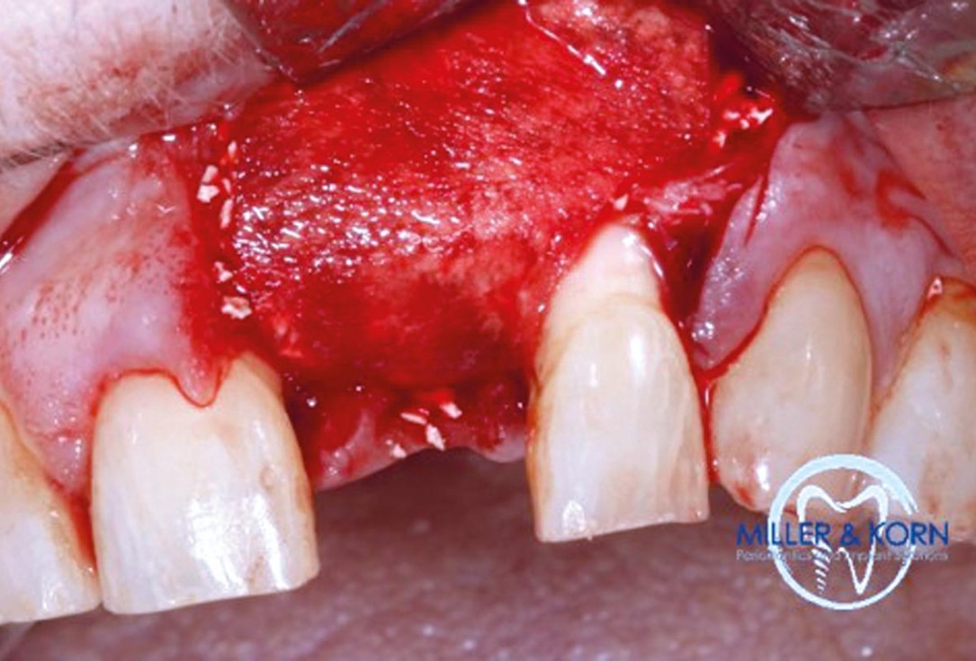 Immediate implant placement and correction of horizontal and vertical bone loss using an allograft bone ring, cerabone® and Jason® membrane - Drs. Miller and Korn