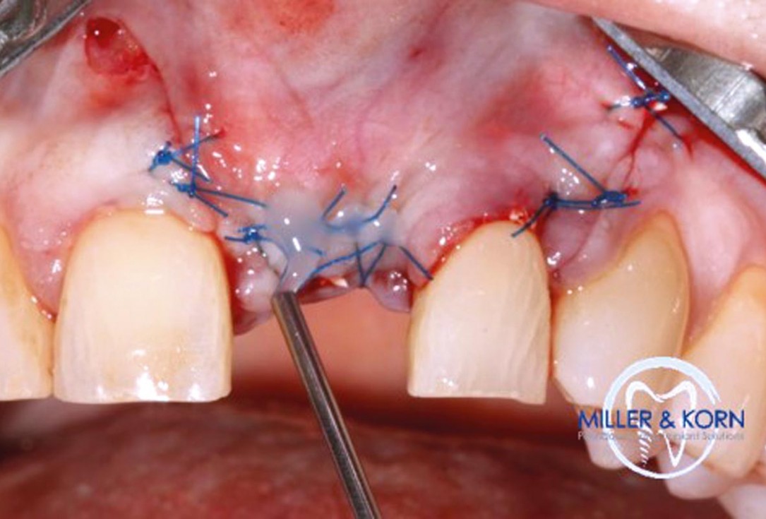 Immediate implant placement and correction of horizontal and vertical bone loss using an allograft bone ring, cerabone® and Jason® membrane - Drs. Miller and Korn