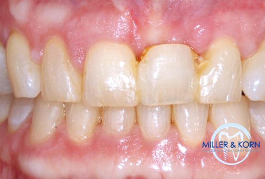 Immediate implant placement and correction of horizontal and vertical bone loss using an allograft bone ring, cerabone® and Jason® membrane - Drs. Miller and Korn