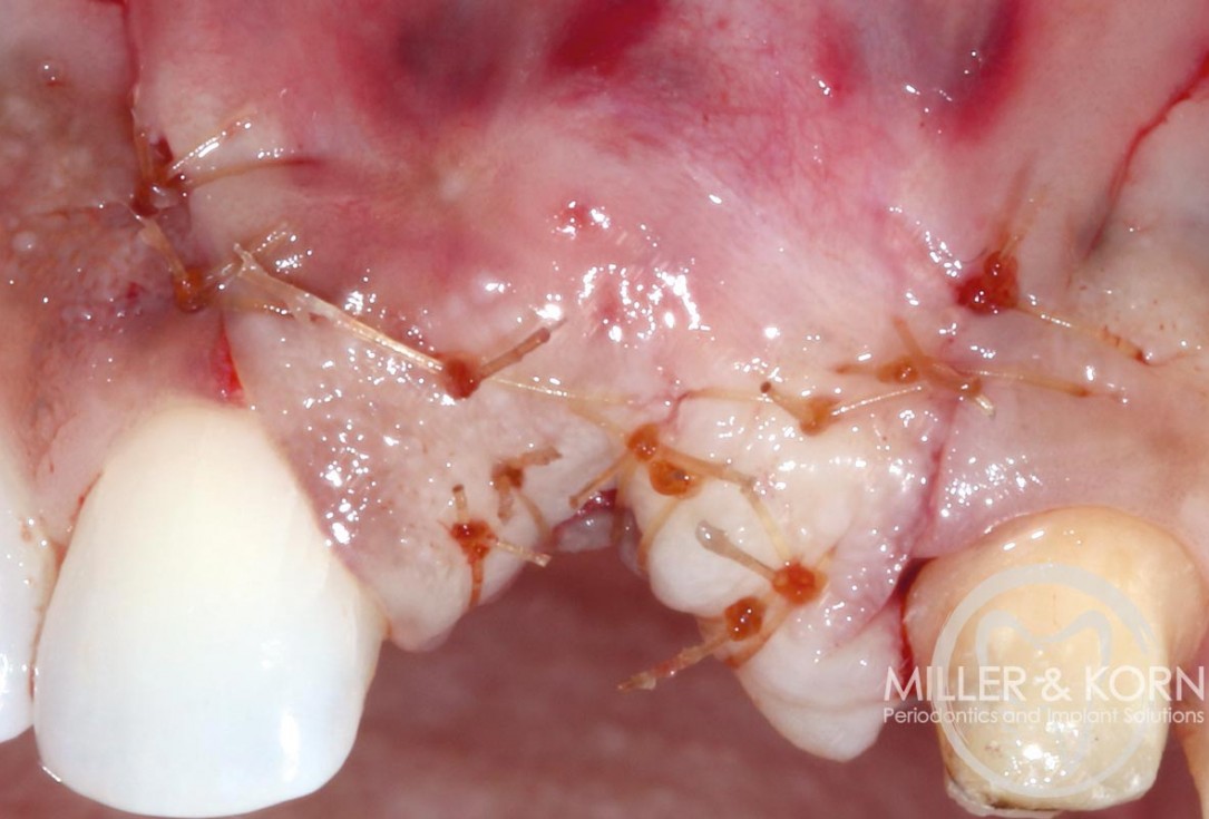Immediate implant placement and regeneration of ridge using an allograft bone ring and Jason® membrane - Dr. Miller and Korn