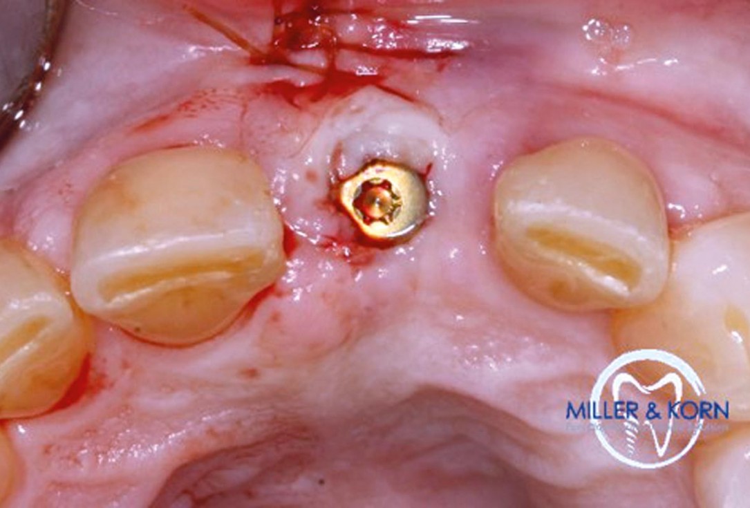 Immediate implant placement and correction of horizontal and vertical bone loss using an allograft bone ring, cerabone® and Jason® membrane - Drs. Miller and Korn