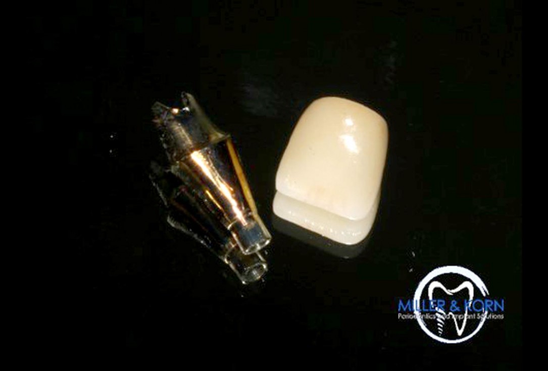 Immediate implant placement and correction of horizontal and vertical bone loss using an allograft bone ring, cerabone® and Jason® membrane - Drs. Miller and Korn